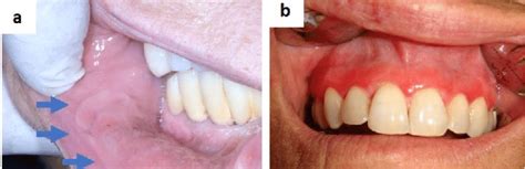 mucosal tags in mouth.